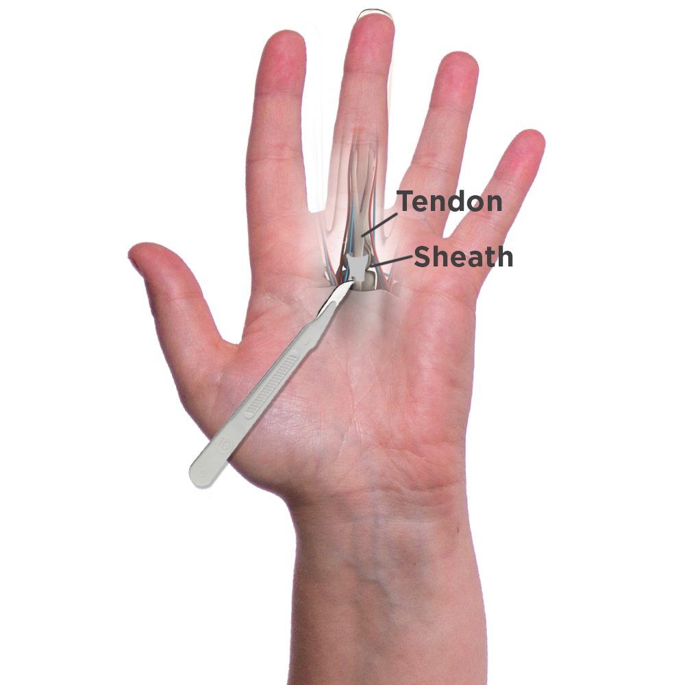 Physical therapy after thumb surgery