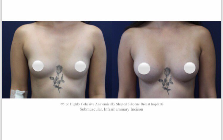 Augmentation breast surgery tehachapi
