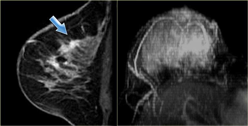 Breast lesions detected by mri