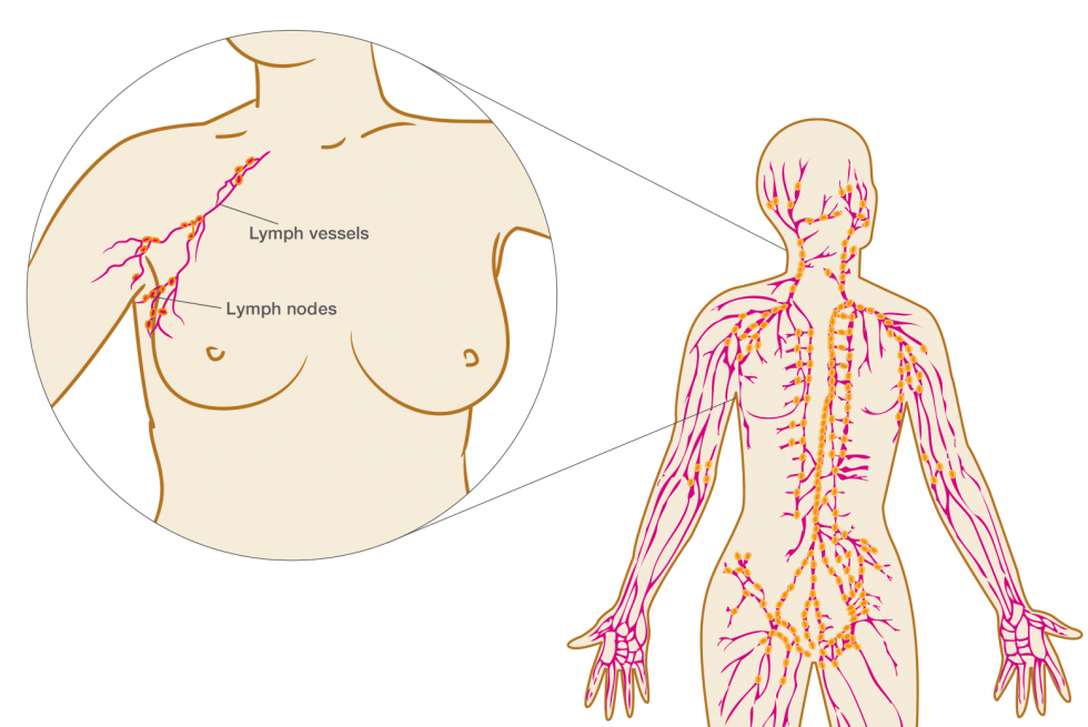 Carcinoma bone breast adema in and