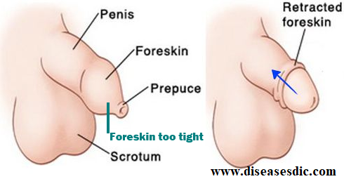 Irritation of foreskin under glans penis
