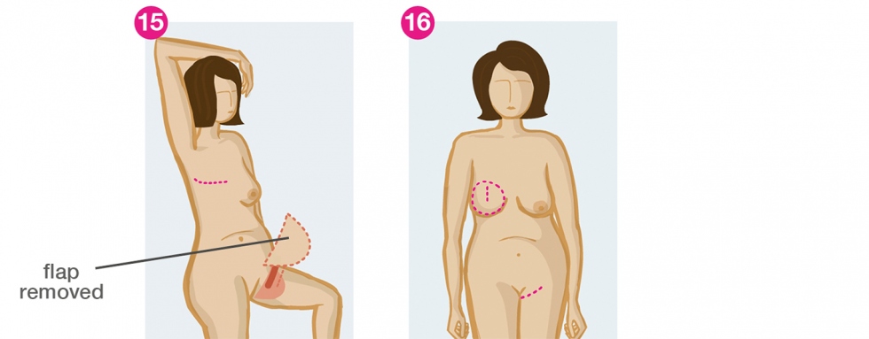 How to soften breast capsular contraction